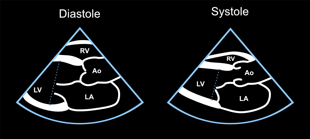 Left ventricular ejection fraction measurement in 2D mode.