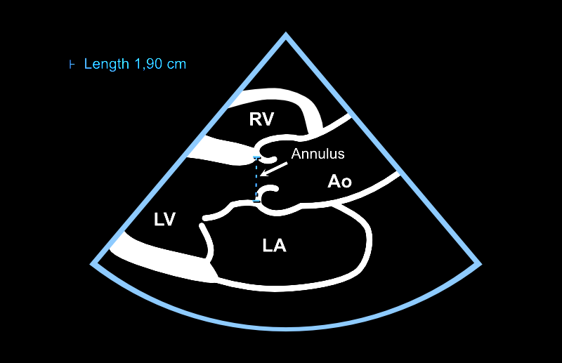 The aortic annulus is measured in mid-systole.