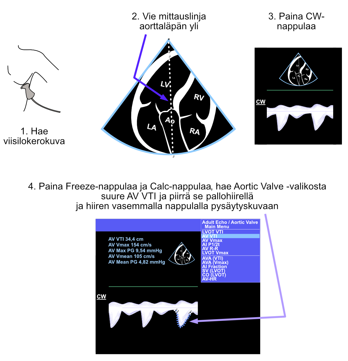 Measurement of the left ventricular outflow tract (LVOT) diameter.
