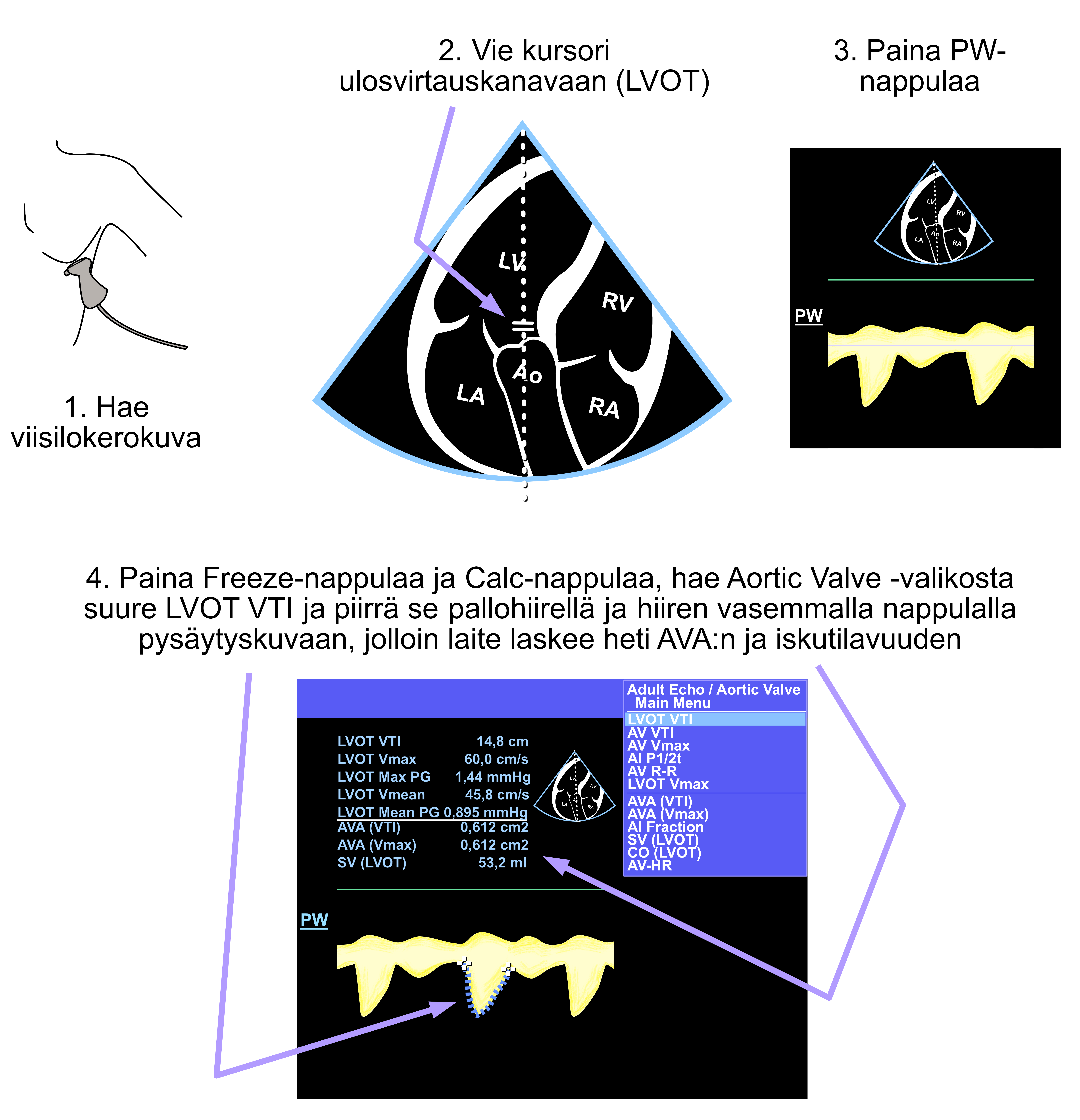 Measurement of the left ventricular outflow tract (LVOT) diameter.