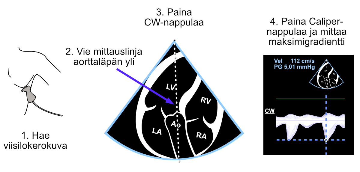 Gradient measurement “unnamed” with the Caliper button across the aortic valve from the continuous wave Doppler signal.