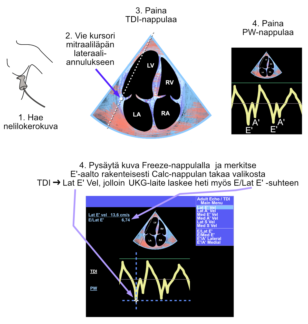 Measurement made with tissue Doppler in diastology assessment. Note the blue-red image, which is seen as an indication of tissue Doppler activation. Since both E’- and A’-waves are seen, the patient is in sinus rhythm.