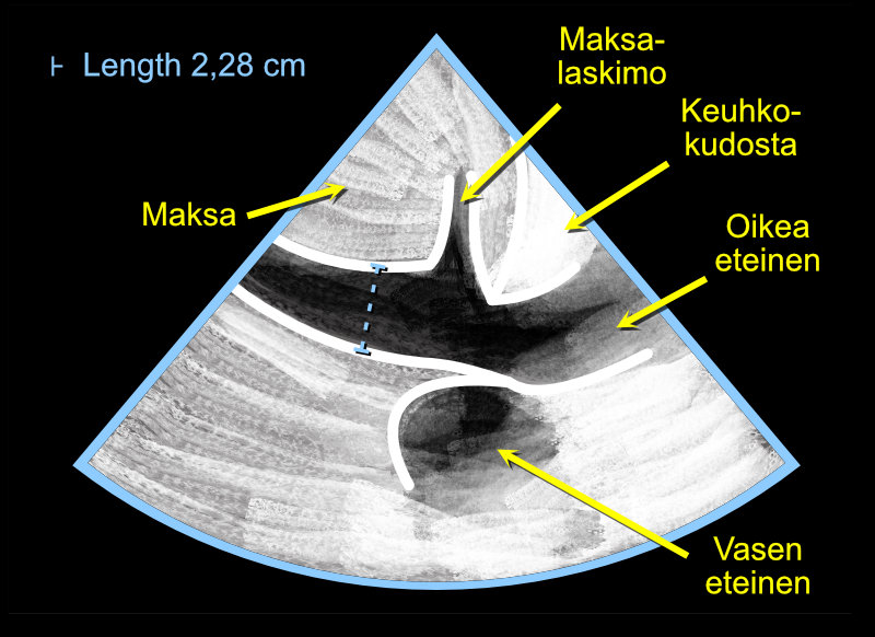 Measuring the diameter of the inferior vena cava (IVC) using the Caliper button. Note. Measure the diameter both during expiration and inspiration.