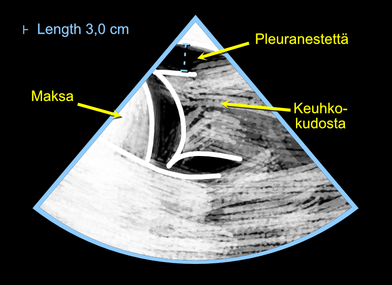 Assessing the amount of pleural effusion using a cardiac ultrasound device.