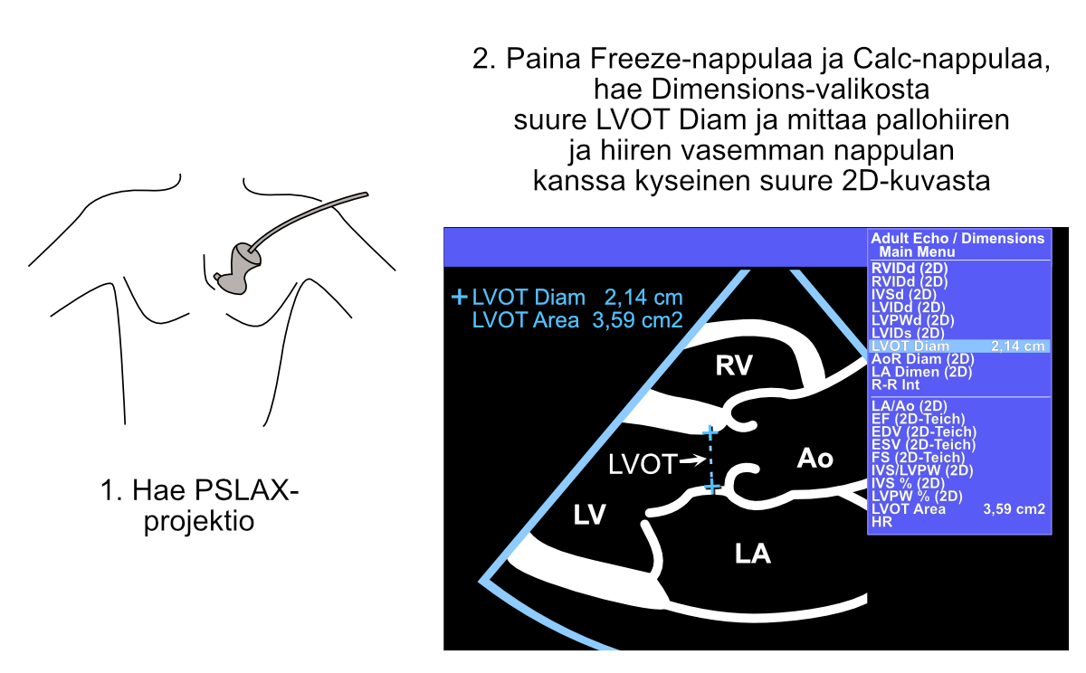 Measurement of the left ventricular outflow tract (LVOT) diameter.