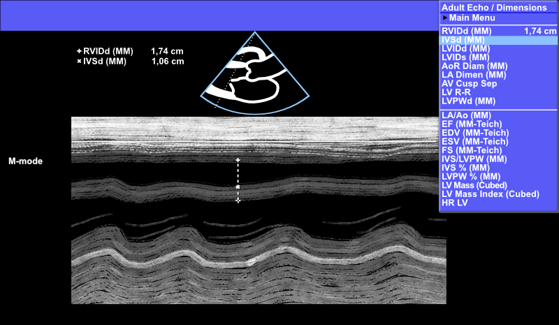 Interventricular septum (IVS) measurement using M-mode.