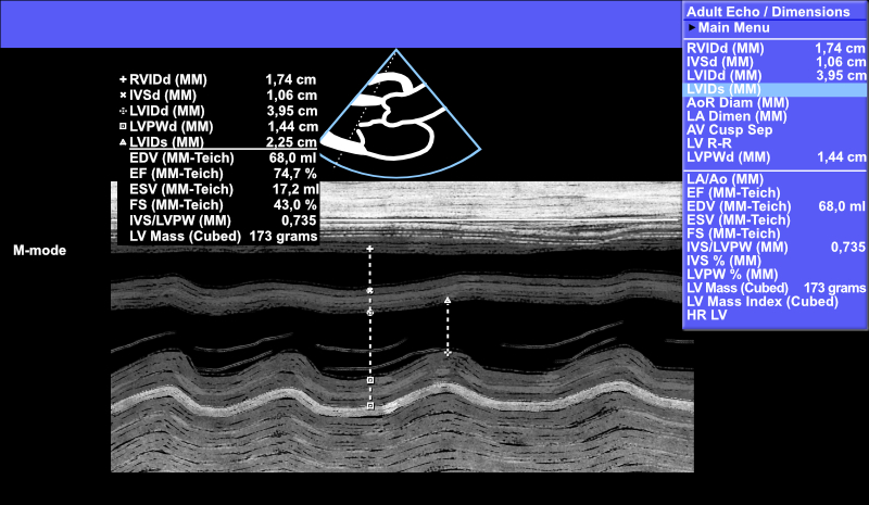 Left ventricular systolic diameter (LVIDs) measurement using M-mode.