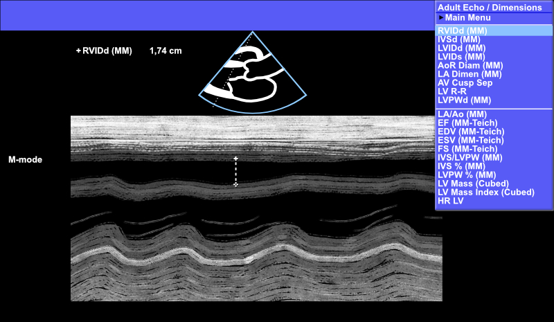 Right ventricular (RV) measurement using M-mode - rarely performed measurement.
