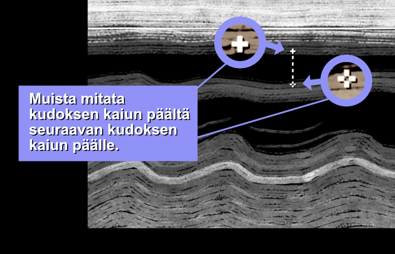 Always remember to measure from tissue to tissue (cardiac tissue appears gray, not black).
