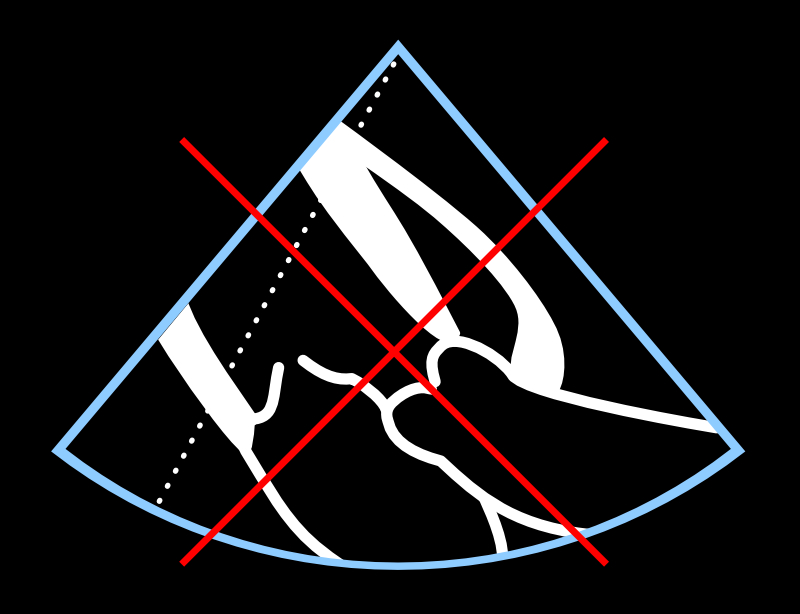 This is not a proper PSLAX projection - don’t try to make measurements from such a projection using M-mode.