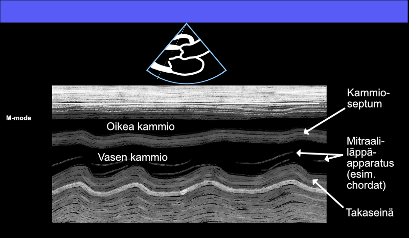 Basic M-mode view in PSLAX projection.