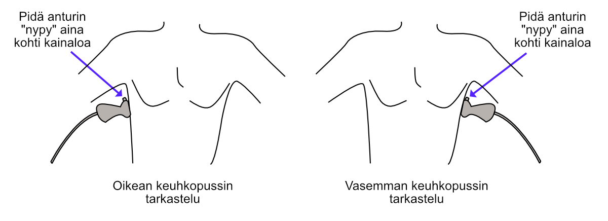 Measuring the inferior vena cava (IVC) using the Caliper button.
