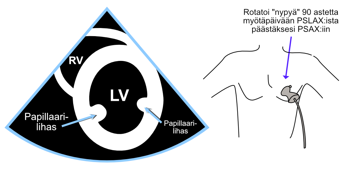Parasternal short-axis view (PSAX).