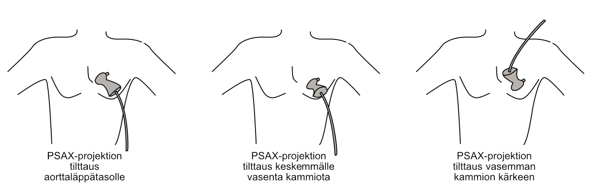 Tilting of the parasternal short-axis view to different cross-sectional levels.