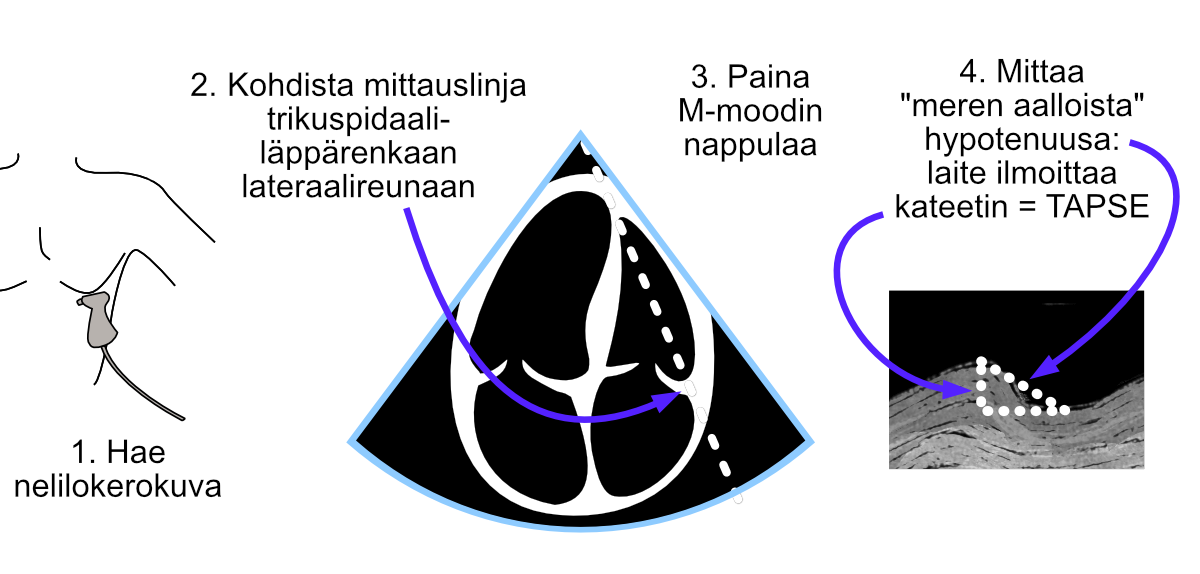 TAPSE measurement using M-mode.