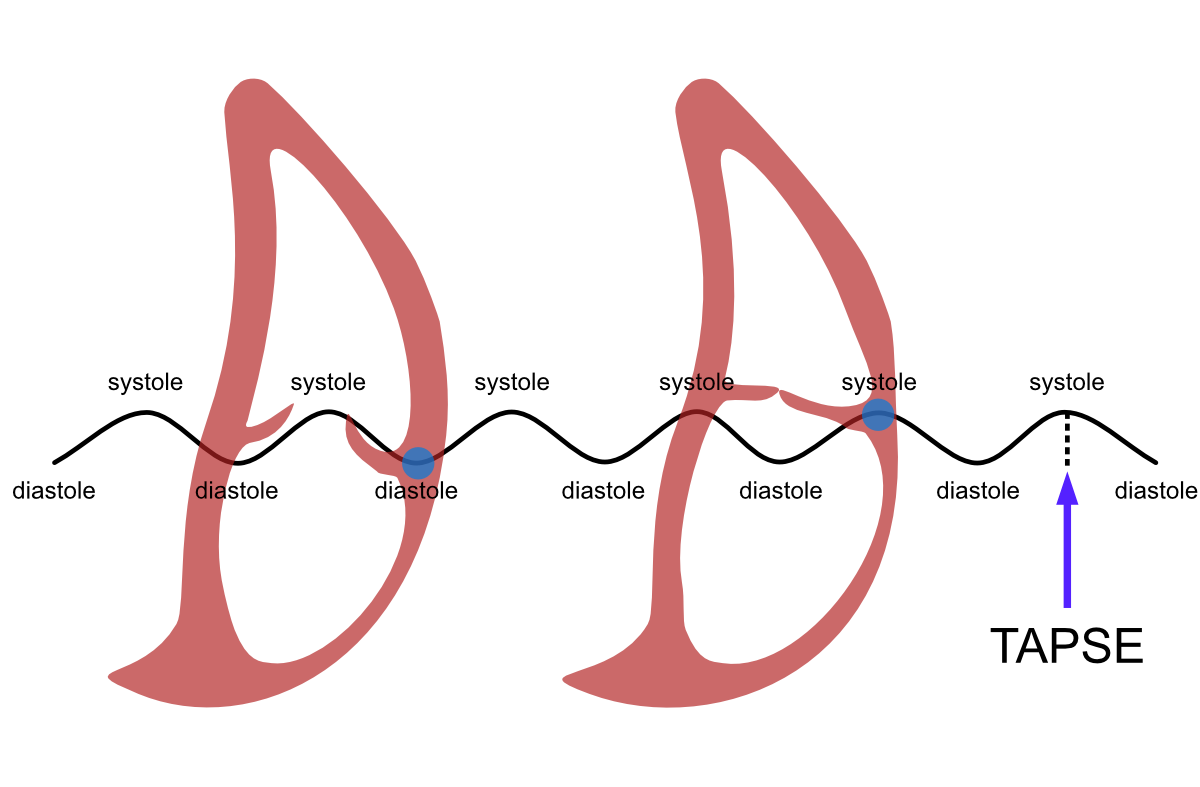 Definition of TAPSE. When the observation point (blue ball) is the lateral edge of the tricuspid annulus, the right ventricular movement between diastole and systole draws “sea wave”-like movement. The amplitude of this wave movement is TAPSE.