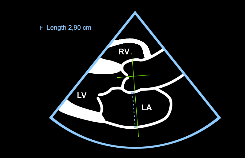 The left atrium is measured with a line that extends from the Valsalva sinus to the left atrial posterior wall in end-systole. The direction of the line must be perpendicular to the imaginary long axis of the aortic root.